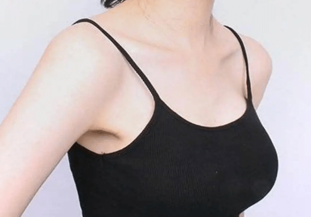 乳房下垂矫正多久消肿？术后需要注意什么？