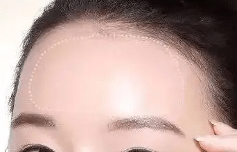 膨体丰额头手术效果怎么样？术后会不会出现肿胀？