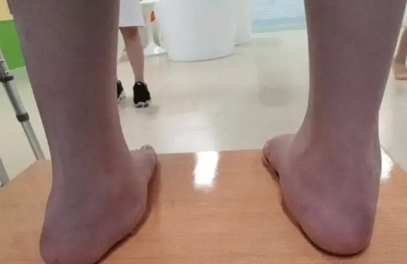 断骨增高后遗症