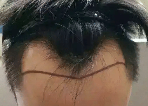 M型脱发的原因是什么？可以通过植发改善吗？