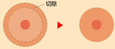 乳晕缩小