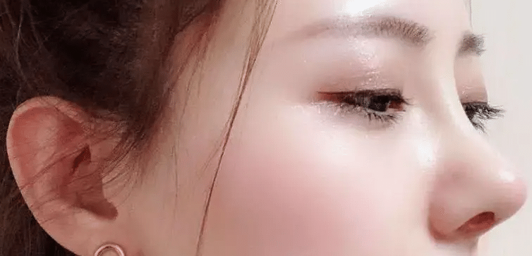 隆鼻后鼻子透光