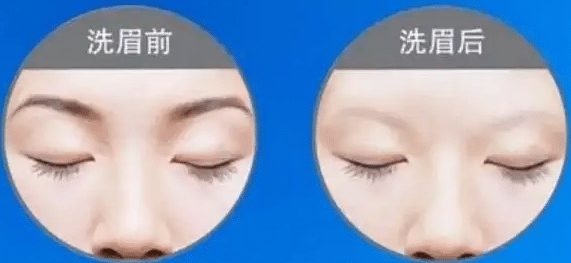 激光洗眉前后对比
