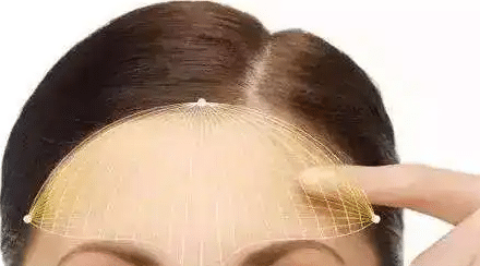 额头不好看怎么办？玻尿酸丰额头可以解决吗？