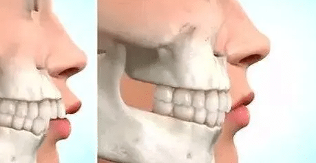 侧面凸嘴是什么原因？可以用双颚手术进行矫正吗？