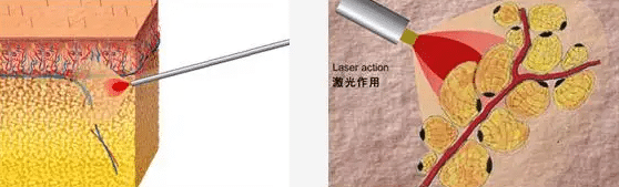 面部光纤溶脂的原理及恢复阶段