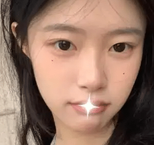 双眼皮失败是免费修复吗？双眼皮修复的四种方法