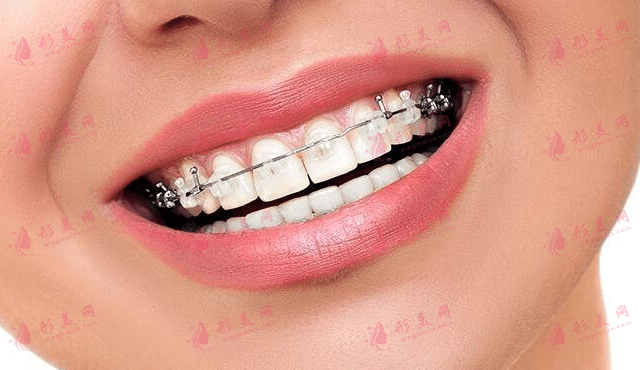 牙套的类型和价格|戴牙套影响口型吗?出现口臭怎么办?