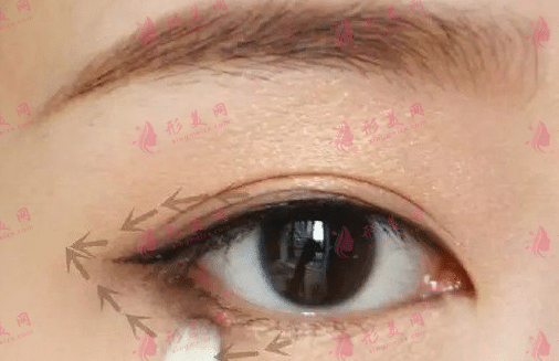 全切双眼皮术后眼尾过长怎么办？多久可以进行修复手术？