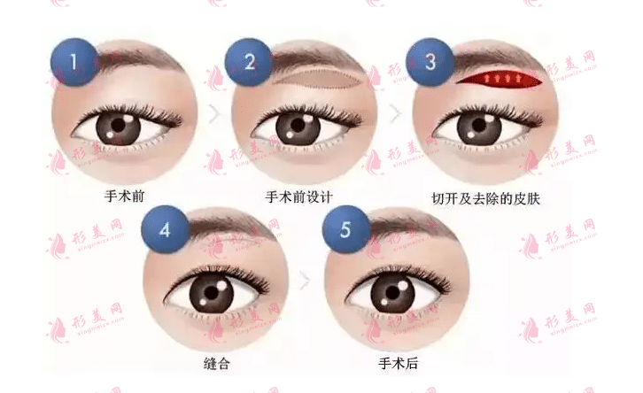 三种切眉方法|做切眉手术的适宜年龄