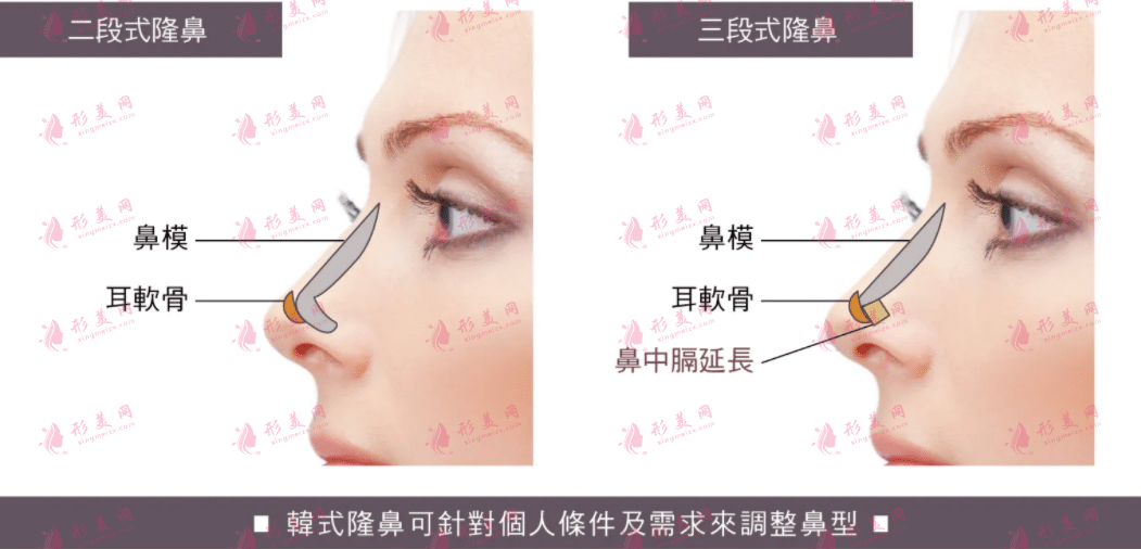 耳软骨隆鼻会被吸收吗?
