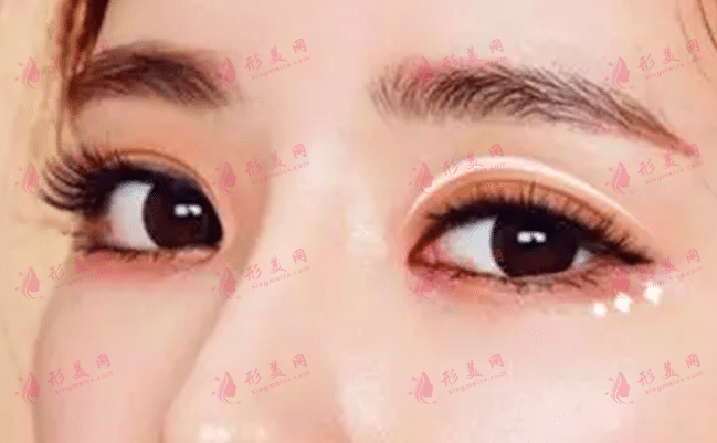 双眼皮