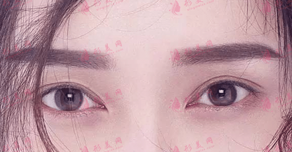 双眼皮修复难在哪里？双眼皮修复的成功率是多少？