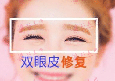 双眼皮修复