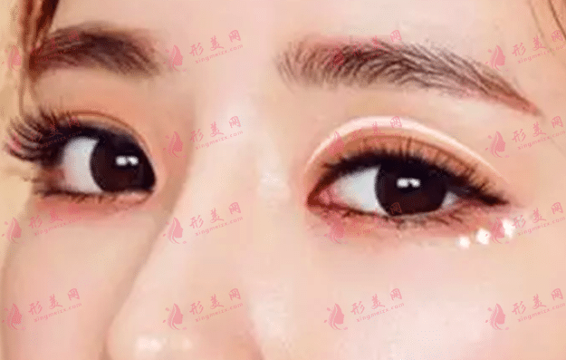 双眼皮