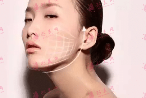 埋线提升