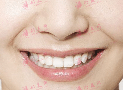 什么是鼻唇沟?不同程度鼻唇沟的不同改善方法