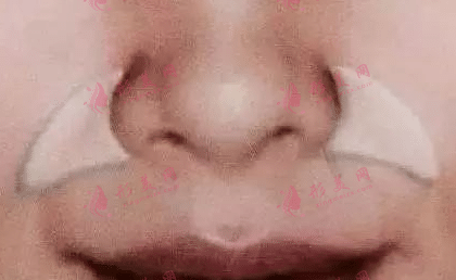 鼻基底