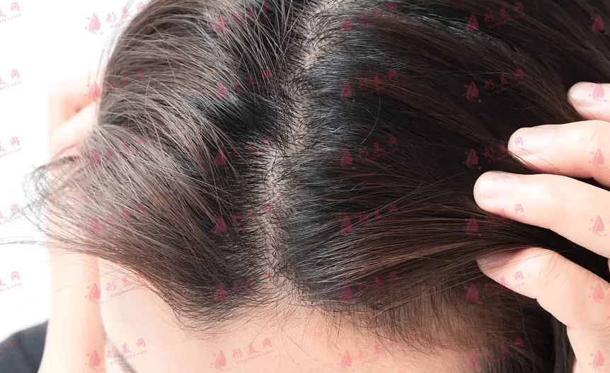如何判定自己存在发际线危机？发际线种植