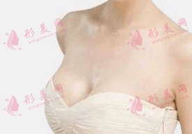 副乳切除