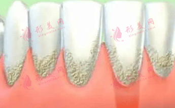 治疗牙龈萎缩的方法|西医治疗、中医治疗