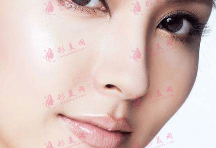 鼻孔缩小术