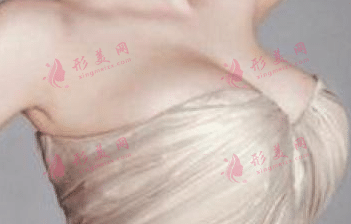 硅胶隆胸到底有多安全?硅胶隆胸有什么副作用?