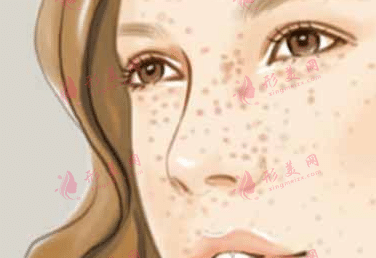 冰冻点痣与激光点痣哪个更好?各自的优缺点