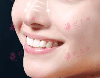 鼻翼缩小术效果如何？术后有无明显疤痕？