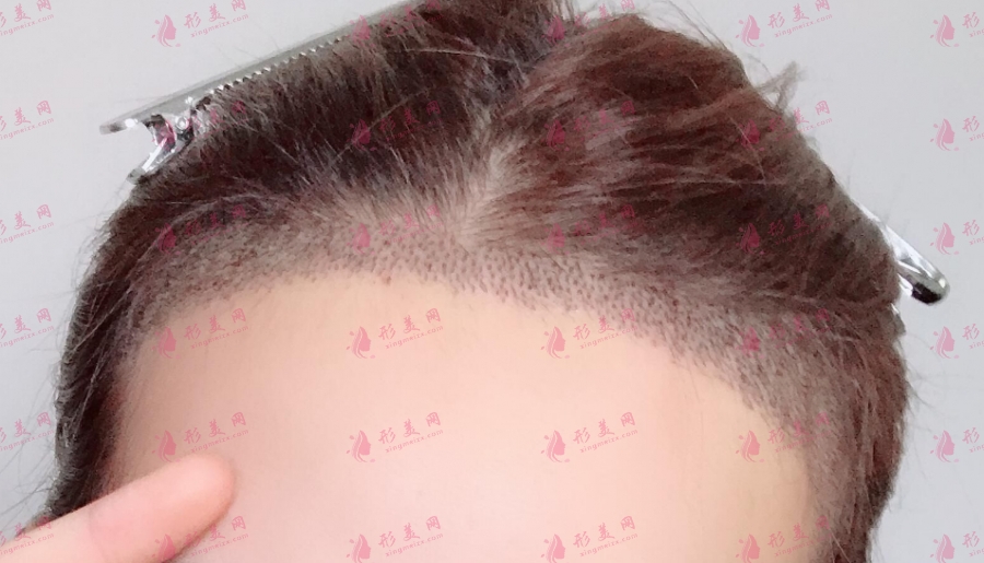 发际线调整后可能会出现的四种后遗症！