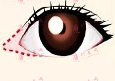 开眼角手术会留疤吗？开眼角的术后注意事项