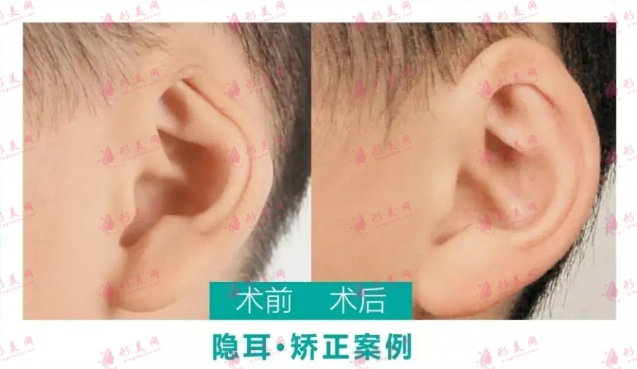 小耳畸形矫正方法