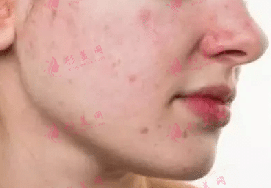 青春痘