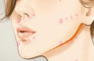 去颊脂垫效果如何？多久可以见到明显效过