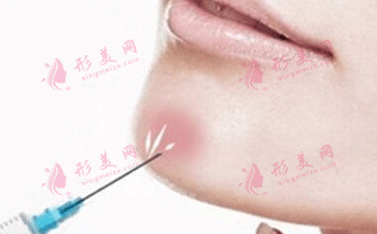 改善下巴轮廓的方法及优势|玻尿酸填充下巴
