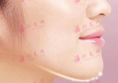 纠正下巴后缩的方法有哪些？纠正下巴后缩的最佳年龄