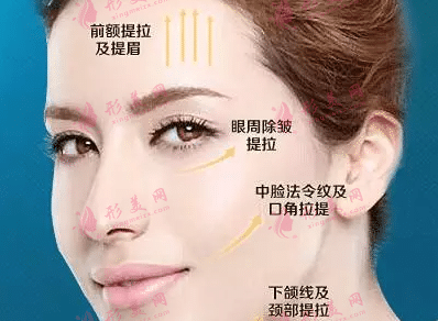 密速提、微拉美、速拉美面部提升技术的优缺点大盘点！
