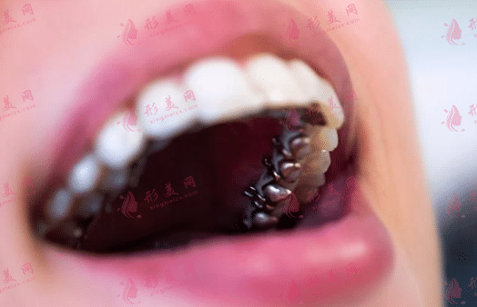 舌侧矫正