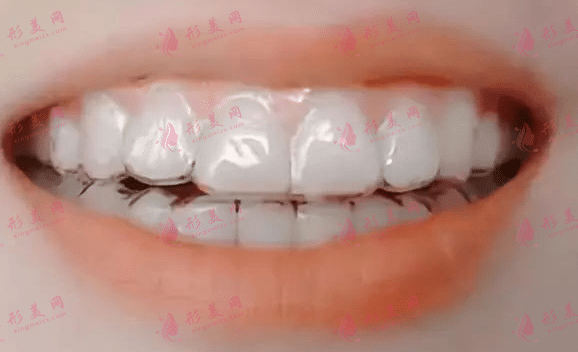 隐形牙套