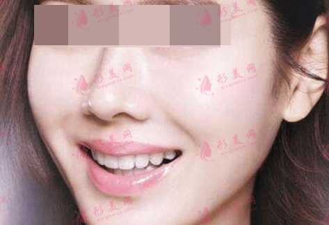 自体面部填充