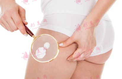 大腿吸脂