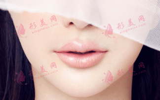 玻尿酸填充法令纹