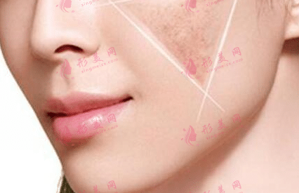 做完皮秒激光后多久可以恢复？术后如何护理？