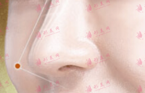 鼻头缩小手术