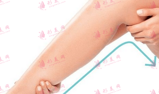 哪些情况适合做小腿吸脂？