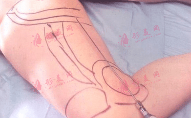 大腿吸脂的两个恢复阶段|大腿环吸后的恢复期是多久？