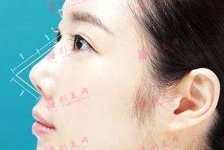 垫鼻尖后多久可以运动？有哪些需要注意的事项？