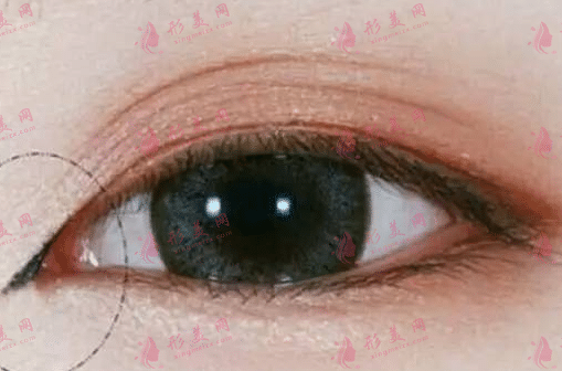 开眼角手术痛不痛？需要忌口多久？