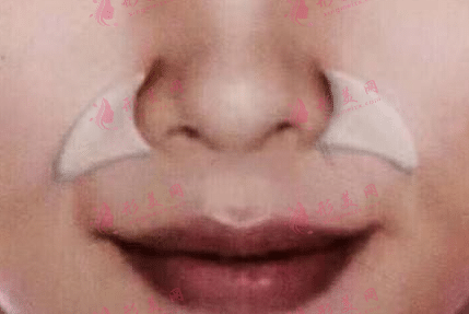 膨体垫鼻基底