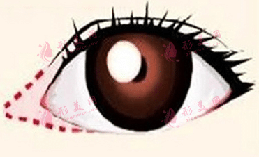 开眼角的伤疤多久会消失？开眼角的术后注意事项